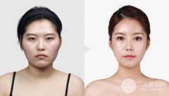 面部整形下颌角矫正术前准备需要做什么?