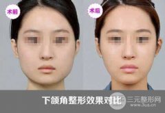 面部轮廓下颌角整形项目有哪些风险?
