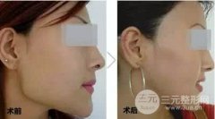 下巴整形填充材料应该如何选择?