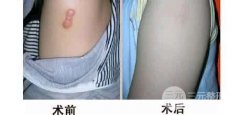 皮肤美容激光去疤痕的果好不好？