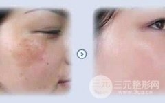 皮肤美容面部去疤果好不好?