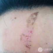 祛疤果真人分享，疤痕体质术后会反弹吗？