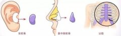 隆鼻喜欢用什么方法？教你选择适合自己的隆鼻方式