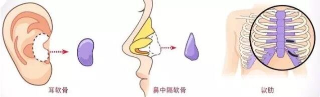 隆鼻喜欢用什么方法?教你选择适合自己的隆鼻方式
