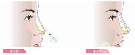 隆鼻喜欢用什么方法?教你选择适合自己的隆鼻方式