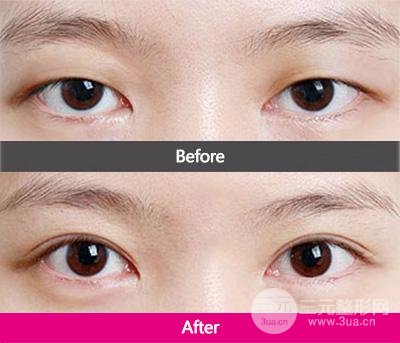 眼皮下垂怎么办、上睑下垂解决方法有哪些