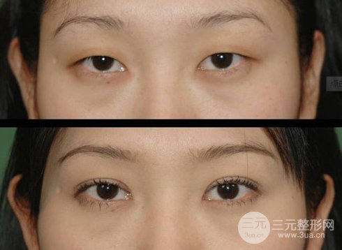 眼皮较薄割双眼皮好还是三点双眼皮比较好