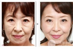 电波l皮可以去除哪些部位的皱纹