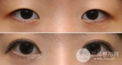 双眼皮术后多久可以怀孕，孕期可以做双眼皮吗
