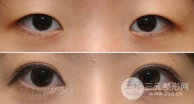 双眼皮术后多久可以怀孕，孕期可以做双眼皮吗