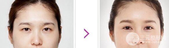 哪些人比较适合做埋线双眼皮
