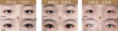 眼皮松弛适合做双眼皮手术吗，有果吗