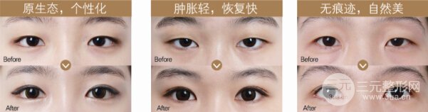 眼皮松弛适合做双眼皮手术吗，有果吗