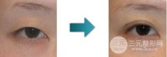 双眼皮手术为什么会失败，双眼皮修复有哪些方法