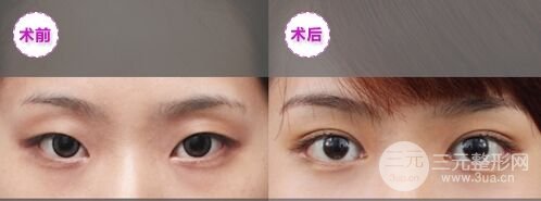 埋线双眼皮的线可以取出吗