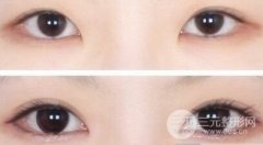 三点定位双眼皮果怎么样，可以持续多久