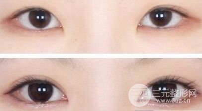 三点定位双眼皮果怎么样，可以持续多久