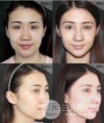 伊婉和瑞蓝用来隆鼻哪个比较好