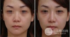 玻尿酸隆鼻和假体隆鼻哪个比较好、如何选择