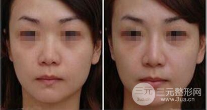 玻尿酸隆鼻和假体隆鼻哪个比较好、如何选择