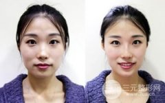 玻玻尿酸隆鼻后会变宽吗，为什么