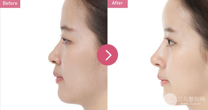 假体隆鼻修复手术要把假体取出吗