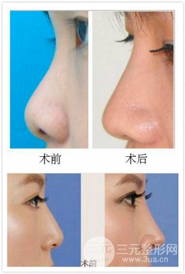 假体隆鼻之后可以再打玻尿酸吗