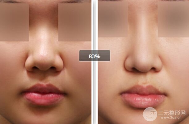 自体软骨隆鼻成好吗，可以保持几年