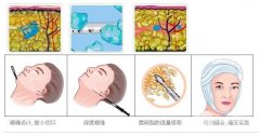吸脂瘦脸果怎么样,好不好 吸脂瘦脸果怎么样,好不好