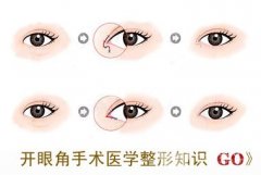 开眼角好不好，有后遗症较轻（不代表不会出现后遗症）多久恢复