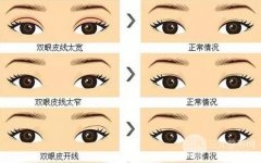 内双可以割双眼皮吗，果怎么样