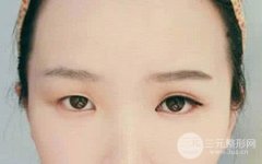 疤痕体质能做双眼皮吗?