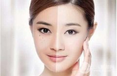 激光美容祛斑果明X吗?