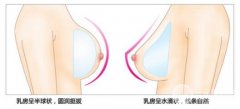 昆明假体隆胸手术的恢复期多长