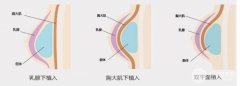 假体隆胸术后护理注意什么