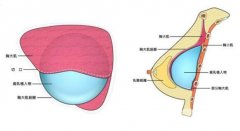 假体隆胸手术有什么样的优点