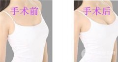 假体隆胸后应该怎么去护理