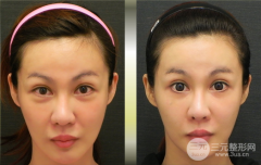 电波l皮除皱多久可以看到果？可以管多长时间