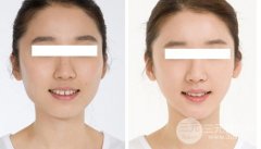 应该怎样选择适合自己脸型的假体下巴？