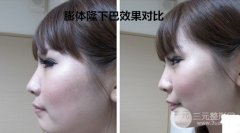 垫下巴膨体好还是硅胶好？多少钱？可以管多久？