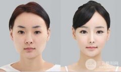 下颌骨整形手术的方法有哪些呢?