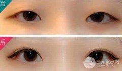 眼部整形双眼皮手术成功的标准是什么?