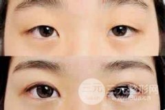 眼部整形切开双眼皮有哪些优点和缺点?