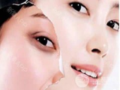 面部年轻化电波l皮项目会有副作用吗?