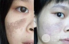 怎么去胎记？北京费用要多少？