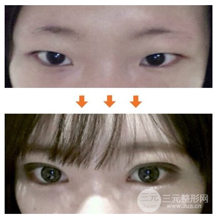 双眼皮手术恢复时间要多久？为什么她恢复得比我快？