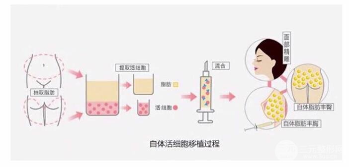 自体脂肪的成活率与哪些因素有关