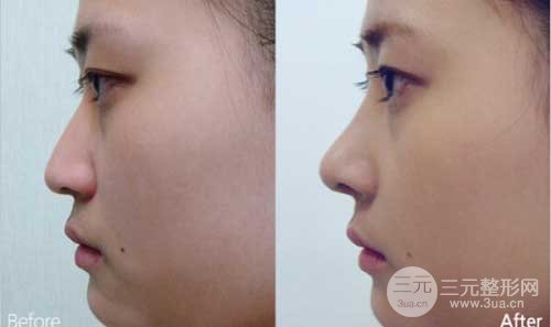 硅胶隆鼻一般保持几年，可以取出吗