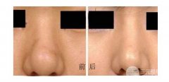 鼻头缩小手术果怎么样、多久能恢复