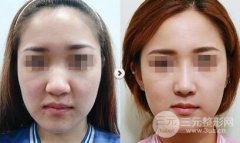 鼻翼过大如何变小、缩小鼻翼方法有哪些